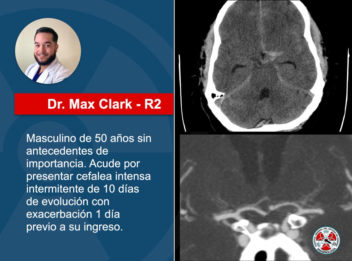 Se presentan imágenes del caso semanal. #ct #radiology #neurology #radres <a href="/maxclarka/">Max Clark</a>