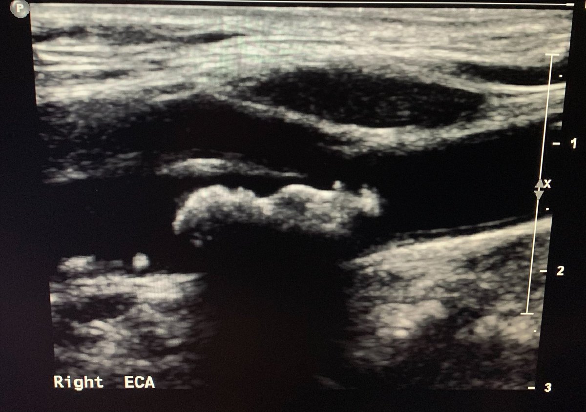 JHHVascular's tweet photo. In this episode of bizarre imaging:
This #carotid is having a . . . Baby?!? ๐ถ๐ผ #vascularlab #duplex @cmholscher @AruRobbie @LaurenLancello https://t.co/O9WSgzmXtf