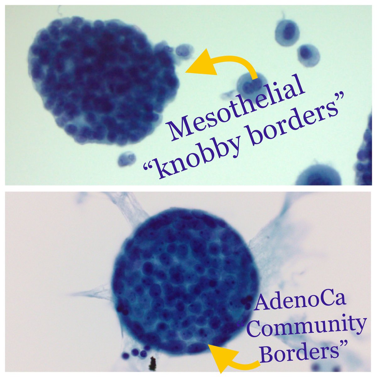 Sara_Jiang's tweet photo. Morulas (latin for mulberries!) were indeed on my mind! Knobby/morular cell balls are characteristic of benign and malignant mesothelial cells in fluids, as opposed to smooth โcommunityโ edges in balls of metastatic adenocarcinoma. Exceptions of course exist ๐คท๐ปโโ๏ธ
#CytoPath https://t.co/ufSIkt7Z4f