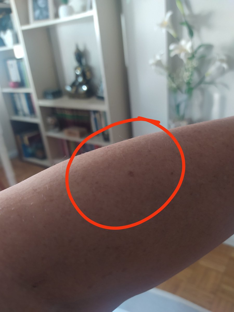 MarujaDesespera's tweet photo. Joer, me acaban de decir que todos tenemos este lunar en esta parte del brazo 😲 https://t.co/Dktlp3Jxdk