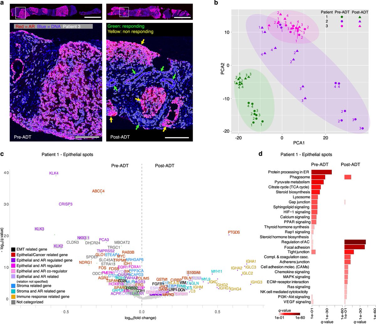NatureComms's tweet image. #SpatialTranscriptomics analysis by @marklund_maja @steffriedrich @joalunatkthse et al. of #ProstateCancer samples before and after androgen deprivation therapy reveals cell populations associated with #TherapyResistance

#CancerResearch @natrescancer

go.nature.com/3Sc3iif