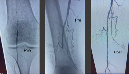 TimHugBD's tweet photo. Pre and Post Rotarex™ Atherectomy SFA occlusion case by Dr. Oak #RemoveWithRotarex

Not for use in the cardiopulmonary, coronary, carotid, cerebral, renal or venous vasculature. Safety info: https://t.co/xzQGwElG88 https://t.co/PdCXHNcfmN