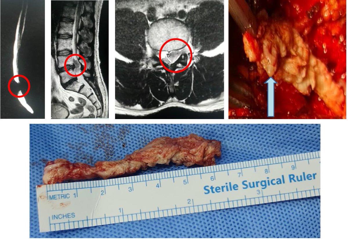 Large lumbar herniated disc causing Cauda Equina Syndrome. Prompt surgery can be rewarding, but remember the dictum- Treat the patient, not the IMAGE.