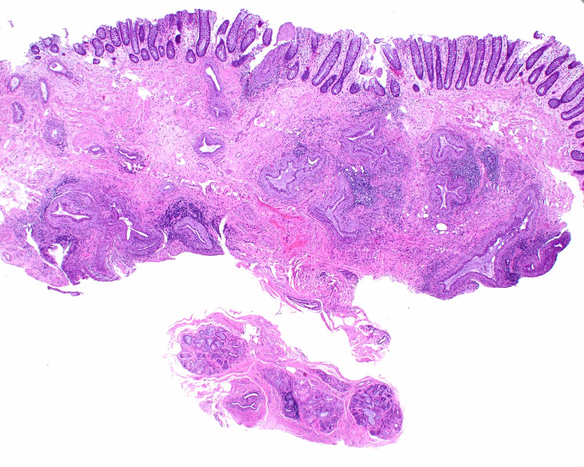 LizMontgomeryMD's tweet photo. Salivary gland heterotopia of the rectum.  Is this like having one's head _______? https://t.co/Dho27pSnH4