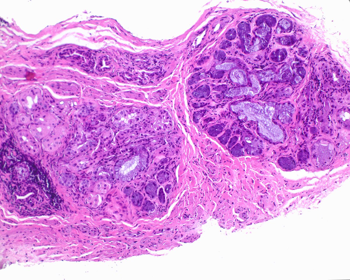 LizMontgomeryMD's tweet photo. Salivary gland heterotopia of the rectum.  Is this like having one's head _______? https://t.co/Dho27pSnH4