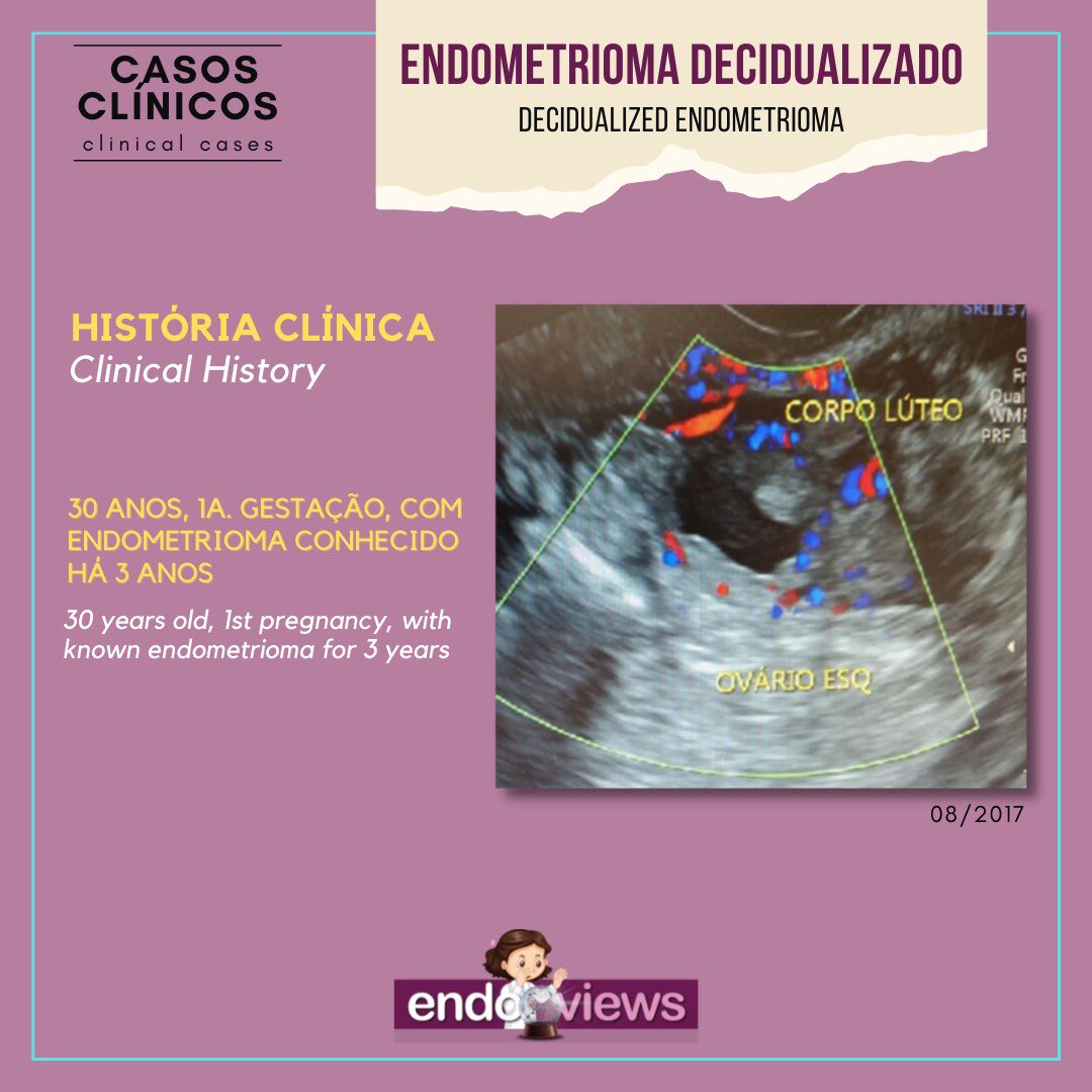 endoviews's tweet photo. Caso clínico: endometrioma decidualizado
Clinical case: decidualized endometrioma
Dra. Luciana Chamié - @lucianachamiec1
Dra. Izabela Pires Franco - @izabelapfranco
Dra. Alice Brandão
🔮Endoviews. O seu banco de imagem em endometriose.
Your image database on endometriosis. https://t.co/sTCbzik6Tl