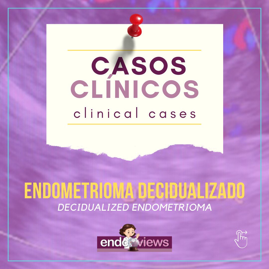 endoviews's tweet photo. Caso clínico: endometrioma decidualizado
Clinical case: decidualized endometrioma
Dra. Luciana Chamié - @lucianachamiec1
Dra. Izabela Pires Franco - @izabelapfranco
Dra. Alice Brandão
🔮Endoviews. O seu banco de imagem em endometriose.
Your image database on endometriosis. https://t.co/sTCbzik6Tl