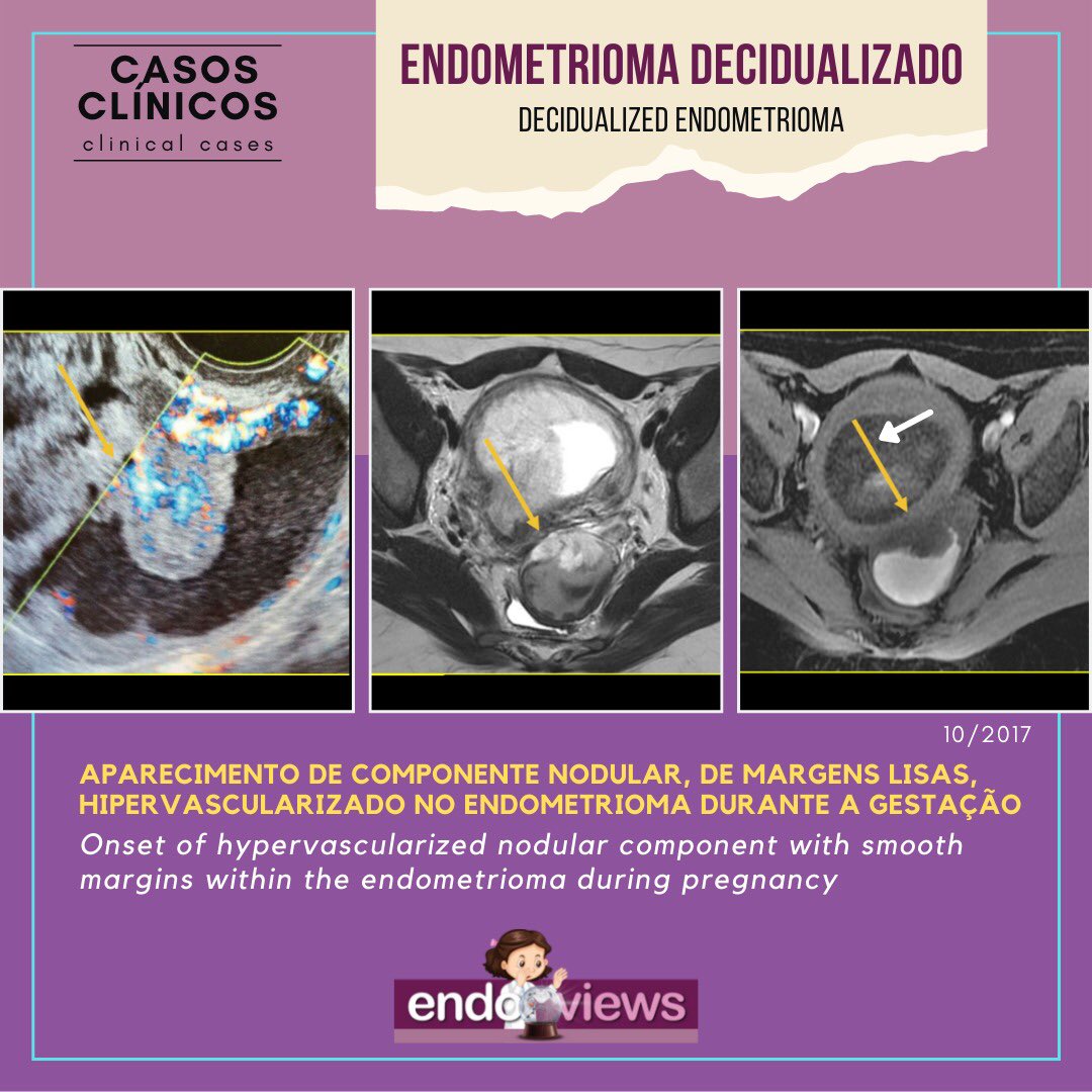 endoviews's tweet photo. Caso clínico: endometrioma decidualizado
Clinical case: decidualized endometrioma
Dra. Luciana Chamié - @lucianachamiec1
Dra. Izabela Pires Franco - @izabelapfranco
Dra. Alice Brandão
🔮Endoviews. O seu banco de imagem em endometriose.
Your image database on endometriosis. https://t.co/sTCbzik6Tl