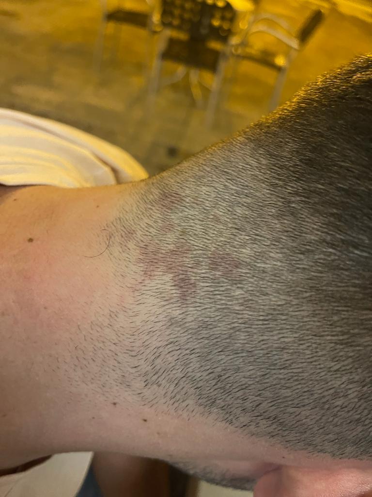 pfarras12's tweet photo. Casi 21 anys i acabo de descobrir que tinc una taca de neixement al clatell https://t.co/Zq6IaAhC2H