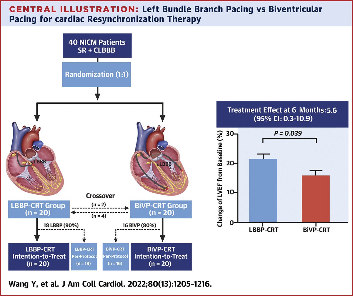 🚨 RCT of LBBP vs BiVP in NICM with LBBB and CRT indication. Crossover rate was high (20%) but the results are practice changing! Is LBBP going to be the standard of care with BiVP as bailout?  @jaccjournals jacc.org/doi/10.1016/j.…