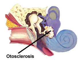 Statistically, 75% of patients with otosclerosis have whistle-like tinnitus, but not all patients with whistle-like tinnitus have otosclerosis.
