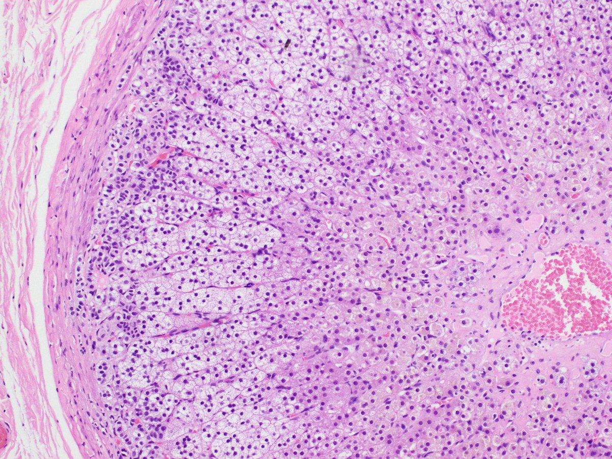 PathAlbanyMed's tweet photo. 🔬Case 1: this little dude was found in the spermatic cord. Can you guess the diagnosis? #pathtwitter #pathology #MedStudentTwitter #MedTwitter https://t.co/Sr5WUHzsxI