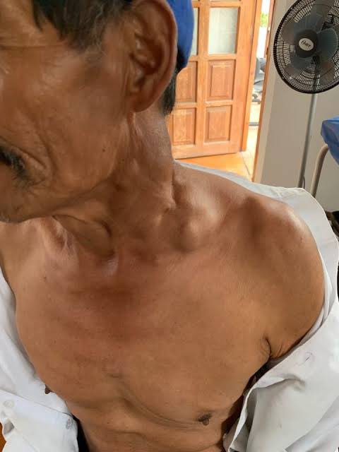 Med4Dummiess_'s tweet photo. SIEMPRE HAY QUE TENER MÁS CUIDADO CON LOS GANGLIOS SUPRACLAVICULARES Y HAY QUE PENSAR EN QUE SON ANORMALES

¿Si el ganglio esta del lado izquierdo en que pensamos? https://t.co/w6Wj8pFZx2