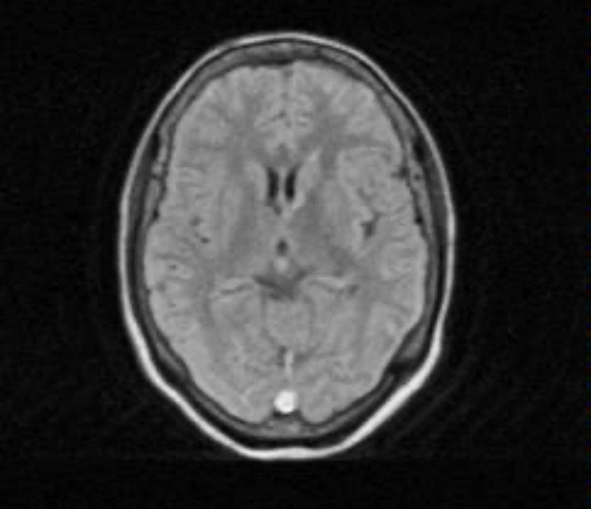 DannySilvaC1's tweet photo. Trombosis seno venoso 0.5% ,causas en este caso Mutación metileno tetrahidrofolato reductasa,hiperhomocisteinemia. Signo del triángulo denso, Signo de la cuerda, Signo delta o del triángulo vacío. 10% mortalidad ⁦@manuveli⁩ ⁦@drdpvera⁩ ⁦@mirellakbr⁩ ⁦#Stroke https://t.co/BiSQp9QJf2