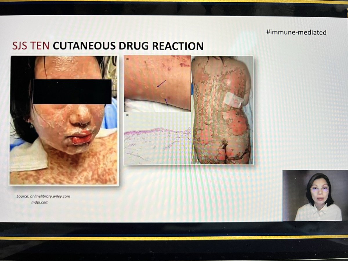 gdyagra's tweet photo. @opihao Check for history of intake of anticonvulsants B lactams, allopurinol #IMpowered2022 https://t.co/pzLARNf4yJ