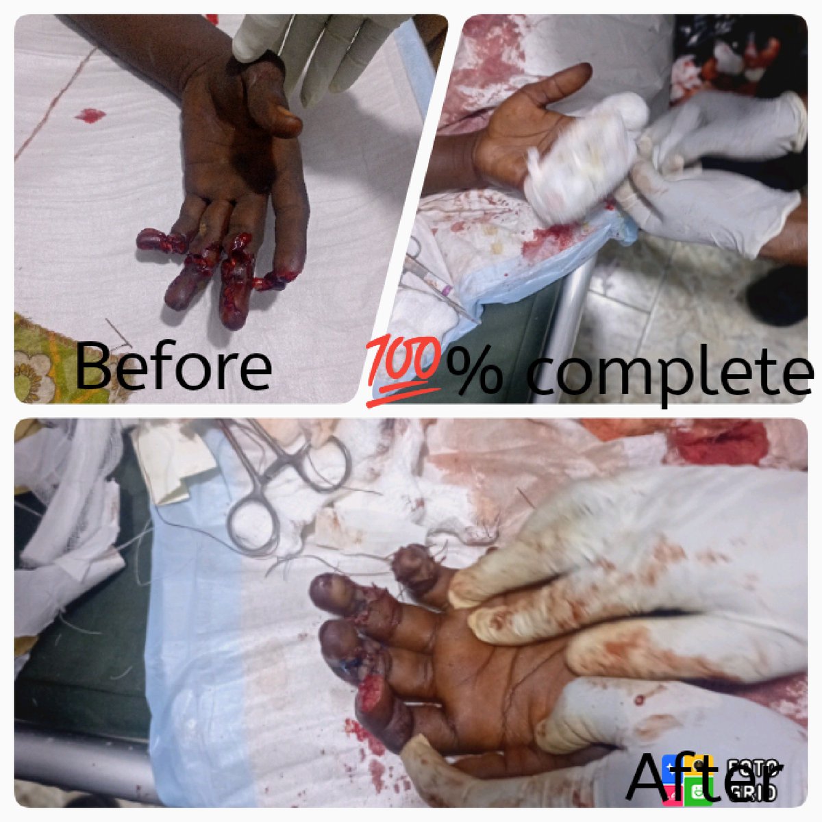 mikdar2009's tweet image. I volunteered to join a nurse and Physician Assistant to conduct an orthopedic surgery to a Financially challenge youth whose family couldn&apos;t afford for aspecialist (Orthopedic surgeon).Our combined efforts made the procedure a success. Service to Humanity is service to theworld