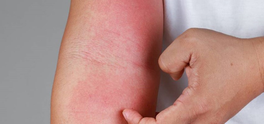 📅 Did you know that last week was National Eczema Week?

Here, Dr Afrina Alam, Consultant Dermatologist answers the top four most Googled questions on eczema:                                                                                               hcahealthcare.co.uk/blogs/eczema-t…