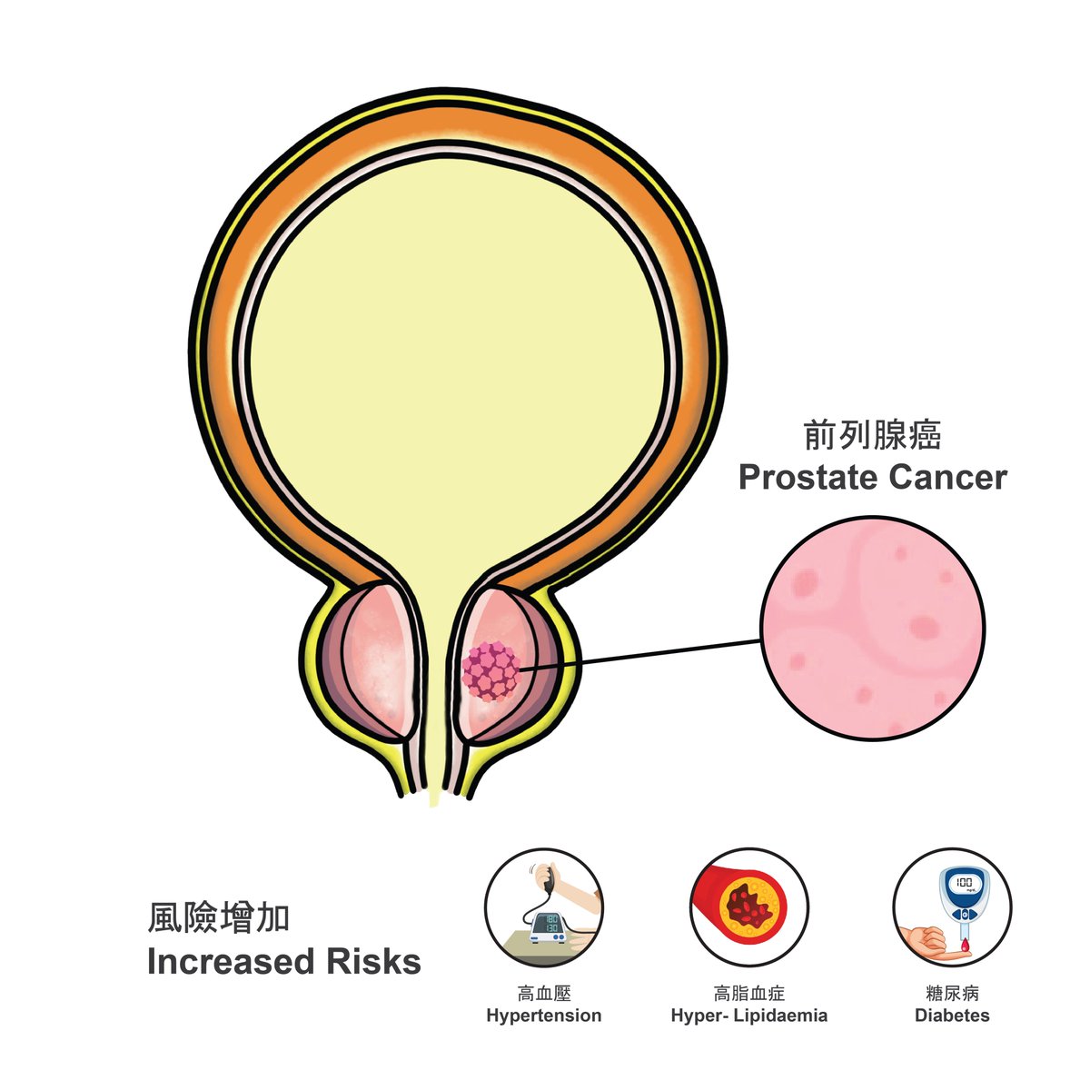 #CUHKUrology found that Chinese receiving ADT are exposed to increased risks of new-onset hypertension, diabetes and hyper-lipidaemia, and a higher likelihood of stepping up pharmaceutical control for pre-existing comorbidities. Details: bit.ly/3MD2zEs