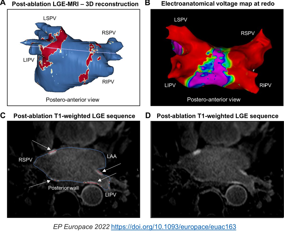 Till Althoff (@tillalthoff) on Twitter photo More and more often we perform highly invasive redos only to find all 4 PVs isolated…
…LGE-MRI can rule out PV reconnection non-invasively. Clear potential to guide patient selection & ablation strategy for redos!
<a href="/LluisMont2/">Lluís Mont</a> <a href="/nmarrouche/">Nassir Marrouche</a> <a href="/Phiso_de/">Philipp Sommer</a>
bit.ly/3BR9sPw More and more often we perform highly invasive redos only to find all 4 PVs isolated…
…LGE-MRI can rule out PV reconnection non-invasively. Clear potential to guide patient selection & ablation strategy for redos!
<a href="/LluisMont2/">Lluís Mont</a> <a href="/nmarrouche/">Nassir Marrouche</a> <a href="/Phiso_de/">Philipp Sommer</a>
bit.ly/3BR9sPw