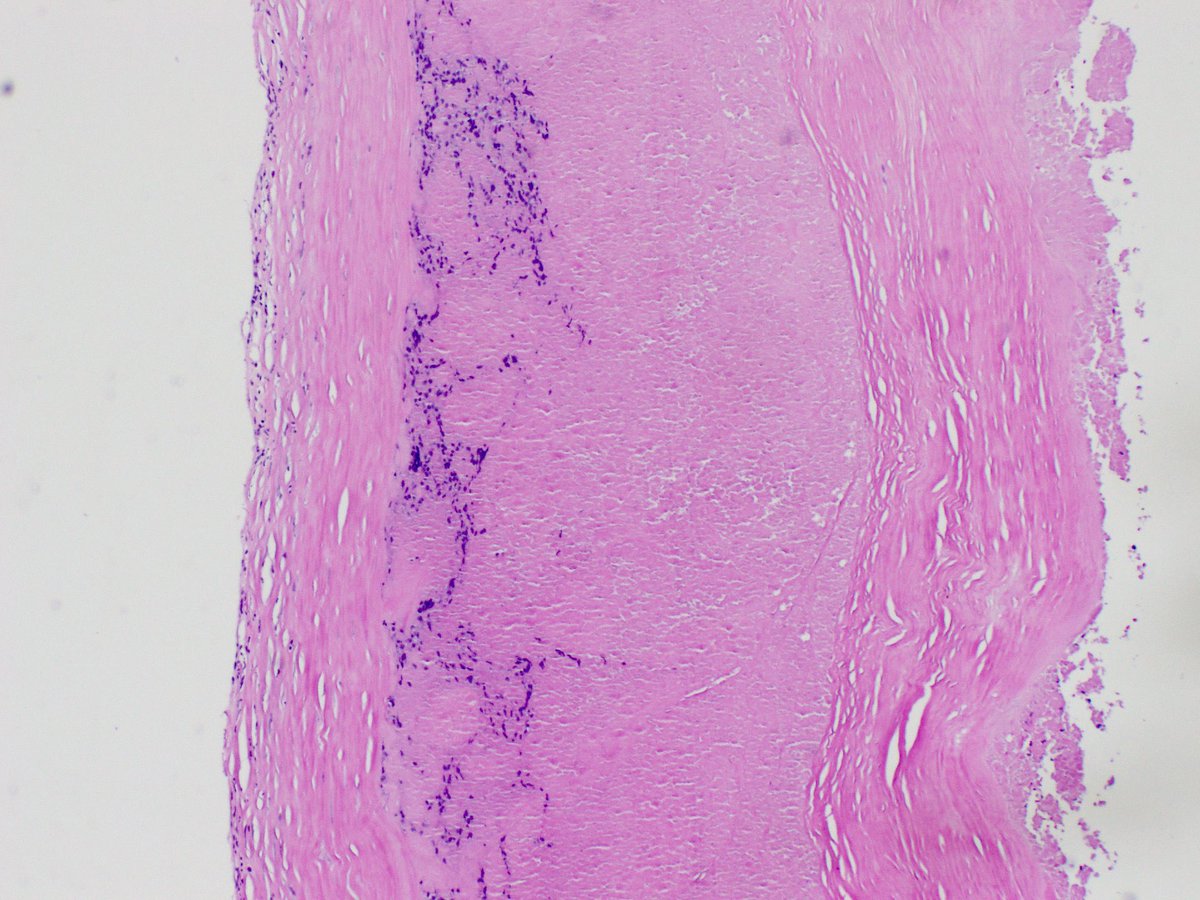 Cristina_VargAP's tweet photo. #BreastPath #HemPath
Am I just showing another Breast-implant associated Anaplastic large cell lymphoma?
Breast capsule seroma fluid with large atypical cells confined to the fluid https://t.co/7N8R5QV49t