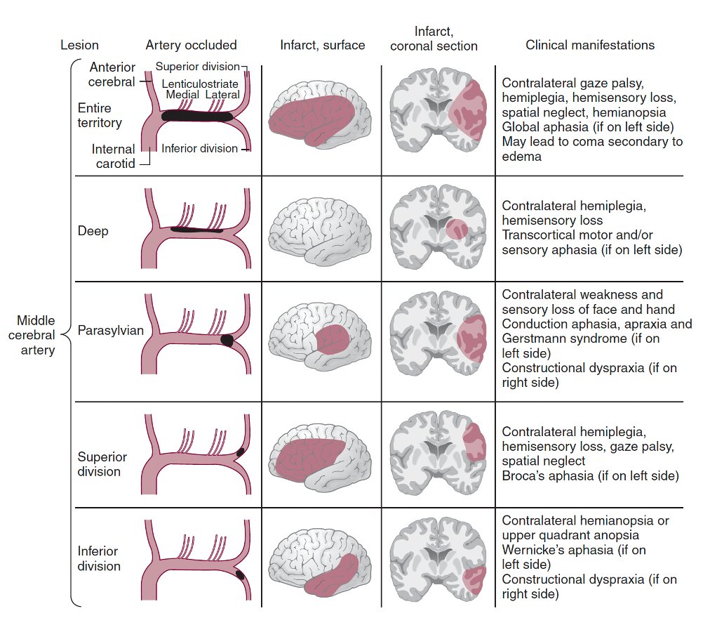 ⭕️ MCA occlusion patters ~🧠 Infarct correlates

via: Caplan's stroke

#MedTwitter #MedStudentTwitter #neurotwitter #MedEd #FOAMed #EndNeurophobia #FOAMrad #radres #NeuroTwitter #NeuroRad #Neurology #Neurosurgery #RadEd #stroke