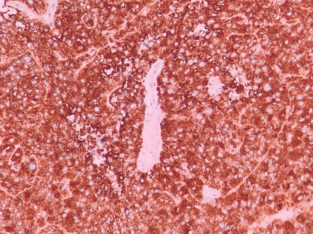 Felipe D'Almeida (@felipepatologia) on Twitter photo Anaplastic PXA with astroblastoma-like perivascular pseudorosettes.
The IHC is BRAF and the V600E mutation was confirmed by NGS.
This case also showed CDKN2A loss and a match for PXA methylation class.
#PathTwitter #neuropath
<a href="/GeronimoJrLapac/">Gerônimo Jr.</a> Anaplastic PXA with astroblastoma-like perivascular pseudorosettes.
The IHC is BRAF and the V600E mutation was confirmed by NGS.
This case also showed CDKN2A loss and a match for PXA methylation class.
#PathTwitter #neuropath
<a href="/GeronimoJrLapac/">Gerônimo Jr.</a>