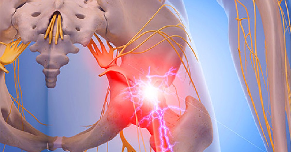 WebMD's tweet photo. Too much sitting and too little exercise, among other things, can irritate and inflame your sciatic nerve -- causing hip pain. https://t.co/XDAkHqX59R https://t.co/dvN9UIPno7