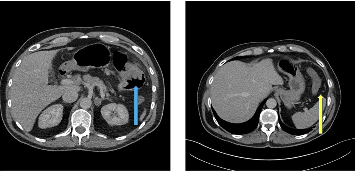 BJS (@BJSurgery) on Twitter photo 2022-10-29 06:44:00 In October's issue of BJS: Neoadjuvant treatment of advanced colonic cancer: a paradigm shift? academic.oup.com/bjs/article/10… @AmyLightnerMD @bplwijn @des_winter @ksoreide @MalinASund @evanscolorectal @nfmkok @robhinchliffe1 @young_bjs In October's issue of BJS: Neoadjuvant treatment of advanced colonic cancer: a paradigm shift? academic.oup.com/bjs/article/10… @AmyLightnerMD @bplwijn @des_winter @ksoreide @MalinASund @evanscolorectal @nfmkok @robhinchliffe1 @young_bjs