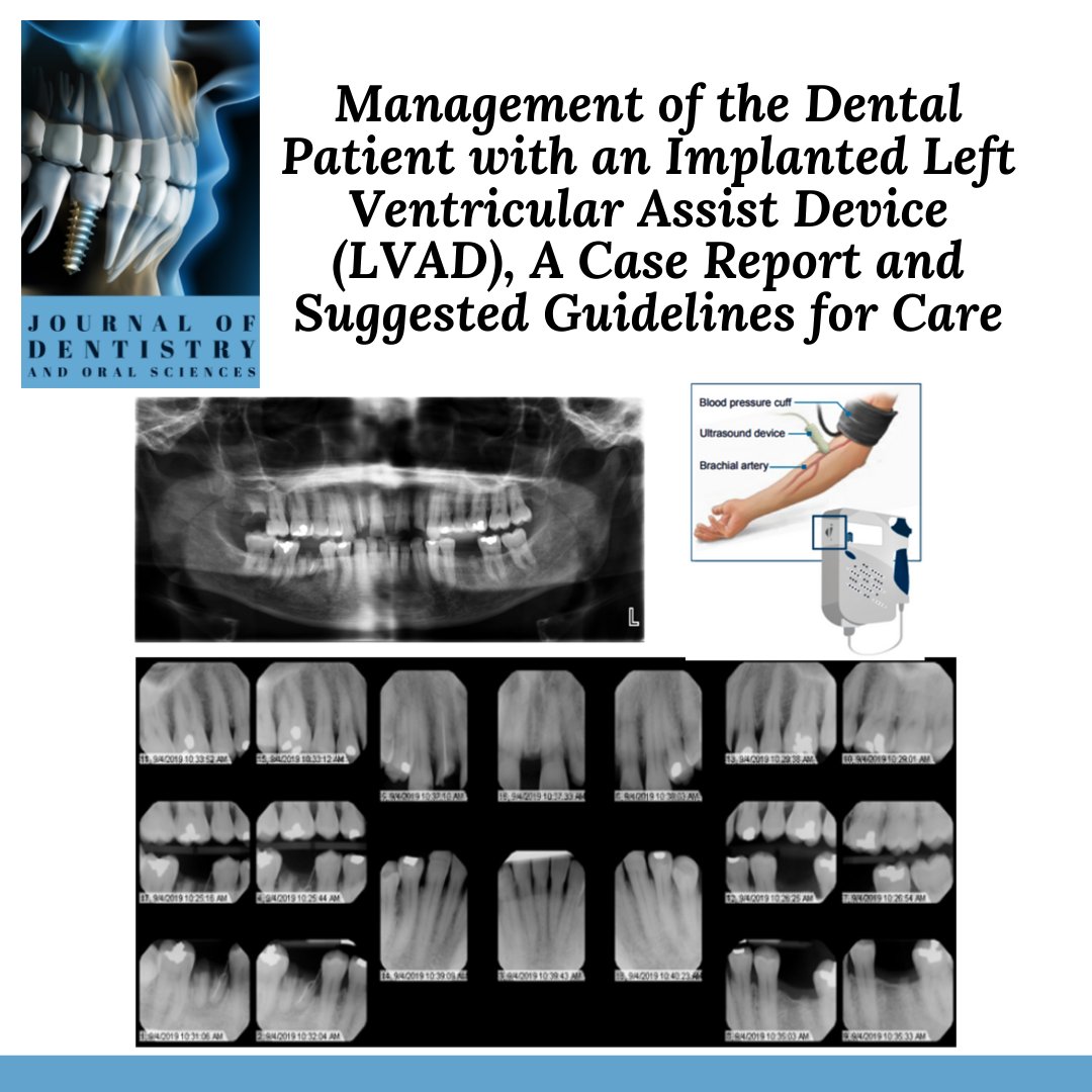 Management of the Dental Patient with an Implanted Left Ventricular Assist Device (LVAD), A Case Report and Suggested Guidelines for Care

Read the full-length article via following link: doi.org/10.37191/Mapsc…

#dental #management #care #guidelines #report #casestudy