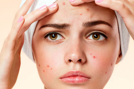 TRATAMIENTO | ¿Sabes cuál es tu mejor tratamiento para el acné? Cada persona requiere de unos cuidados y pautas personalizadas que vienen de la mano de un profesional de la dermatología. 
En nuestro blog te dejamos alguna información
gruposmd.es/mejor-tratamie…
958 870 200