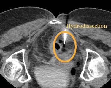 Endovascular Rounds tweet media