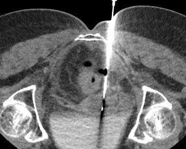 Endovascular Rounds tweet media