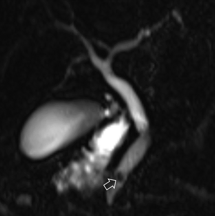 SahajRathi's tweet photo. Middle aged female with episodic pain abdomen

MR showed something in distal CBD

EUS - "Railway track sign", but too small for ascaris. 

Possibly a fluke...

Well, there it was... a live, fluttering #Fasciola hepatica!

#livertwitter #GITwitter https://t.co/4i1BpGDeWU