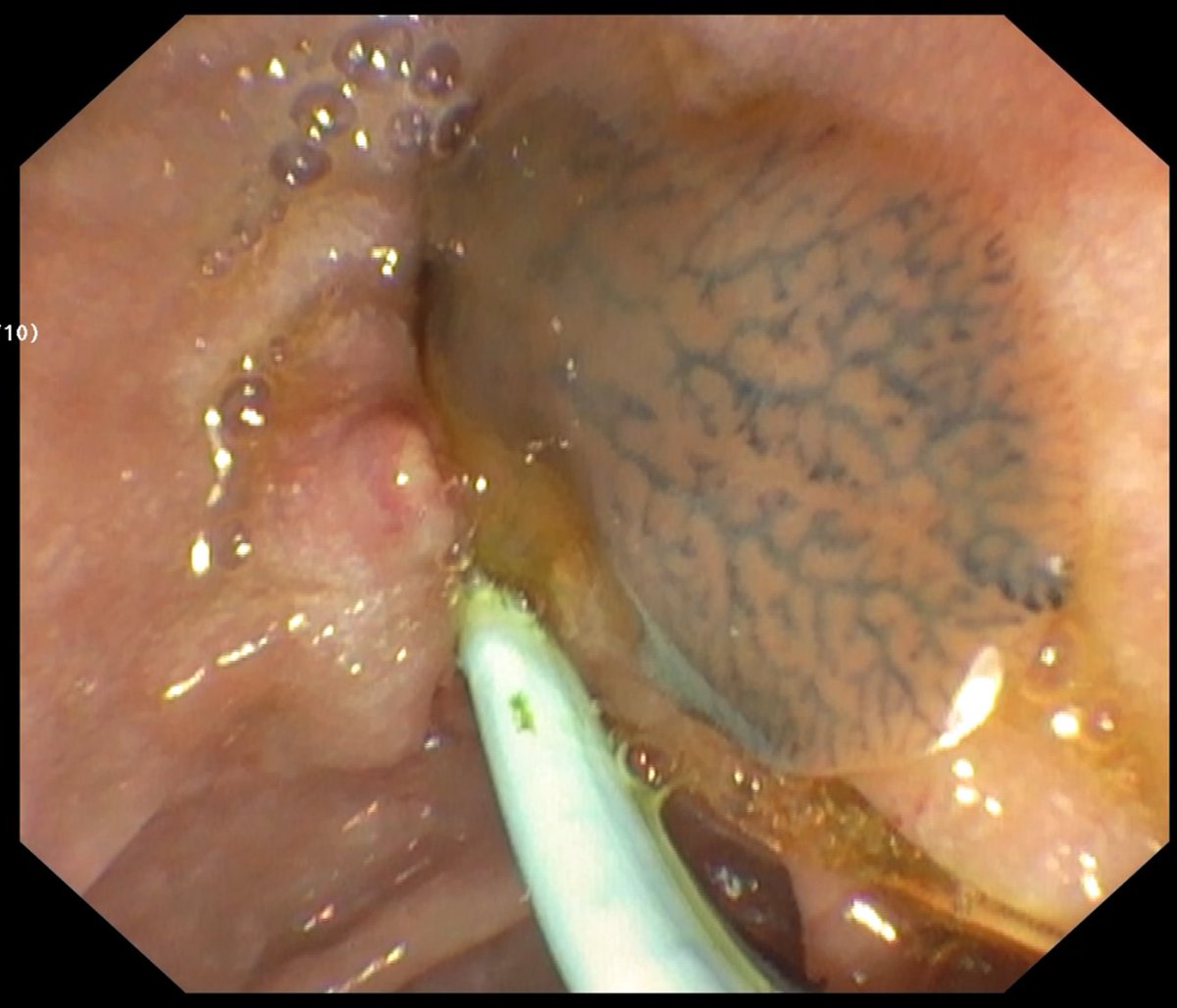 Middle aged female with episodic pain abdomen

MR showed something in distal CBD

EUS - "Railway track sign", but too small for ascaris. 

Possibly a fluke...

Well, there it was... a live, fluttering #Fasciola hepatica!

#livertwitter #GITwitter