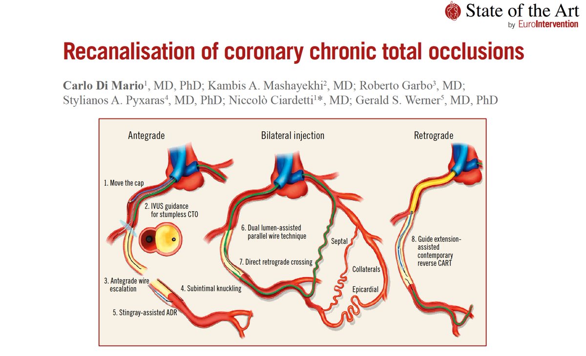 EuroInterventio's tweet photo. ❗NEW ISSUE❗  STATE-OF-THE-ART on RECANALISATION OF CORONARY CHRONIC TOTAL OCCLUSION: a detailed overview of the history, indications and treatment strategies for CTO recanalisation. #EAPCI #cardiotwitter https://t.co/Il3VSvvQxI https://t.co/3Bq2OAbSjV