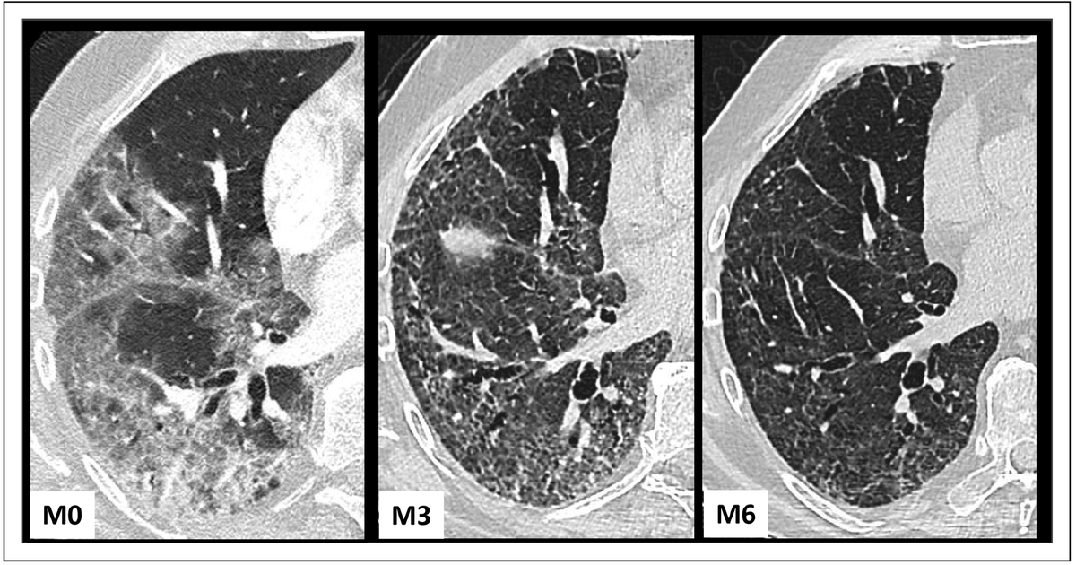 AlfredoPachasMD's tweet image. #Interstitial lung disease following #coronavirus disease 2019 acortar.link/7XnRSb 
📚🔝✔️🔑🩺 🫁  
@bruno_crestani @DrPujaMehta1 @pulmonloco @ALATIntersticio @Juani1000 @laualberti1 @ers_ild @neumobrenda