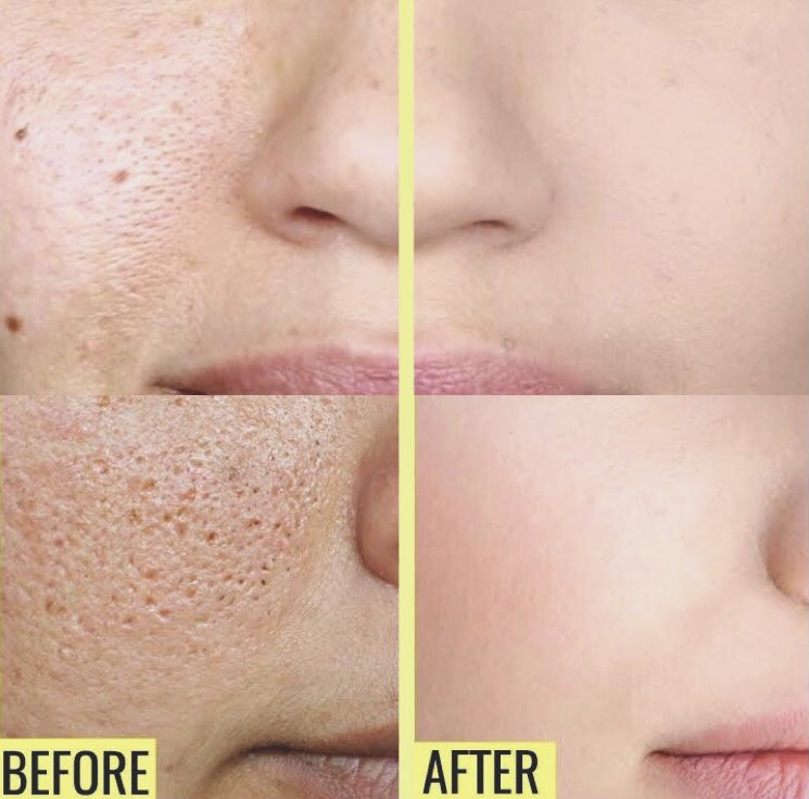 maharanilyss's tweet photo. Rekomendasi masker terbaik untuk mengangkat komedo dan mengecilkan pori-pori

~a thread~ https://t.co/EmEKYgT3ag