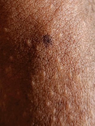 Tenho umas 100 igual a essa espelhadas pelo corpo, quero ver tu adivinhar onde fica essa pinta. https://t