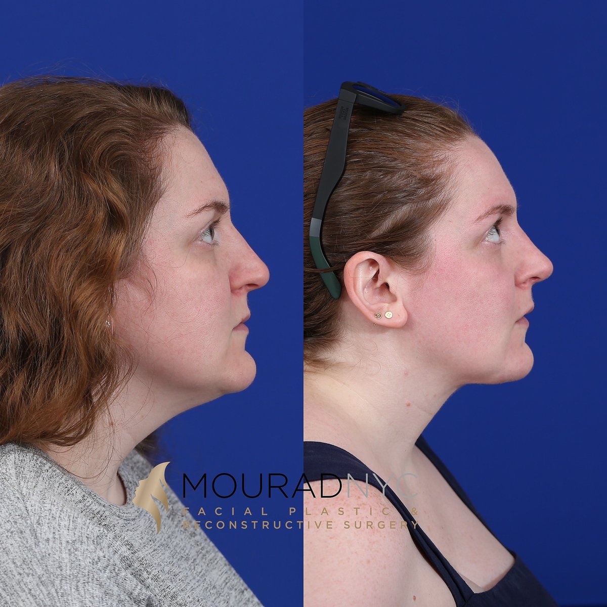 NYCFaceDoc's tweet photo. This wonderful patient of mine came in seeking better contouring of her neck and jawline. She initially sought consultation for neck liposuction. However, careful evaluation and discussions with the patient allowed us to choose a more appropriate course of treatment- a neck lift! https://t.co/C1b6KM8rqm