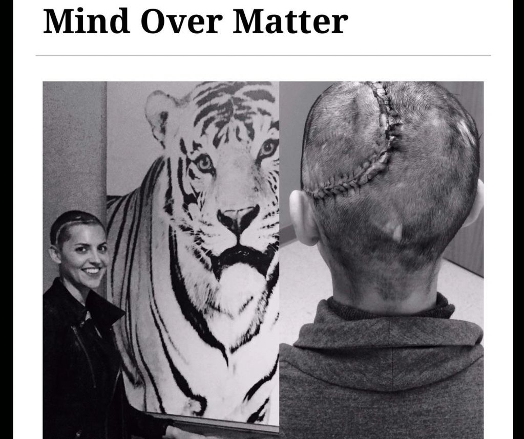 #mindovermatter #TBI