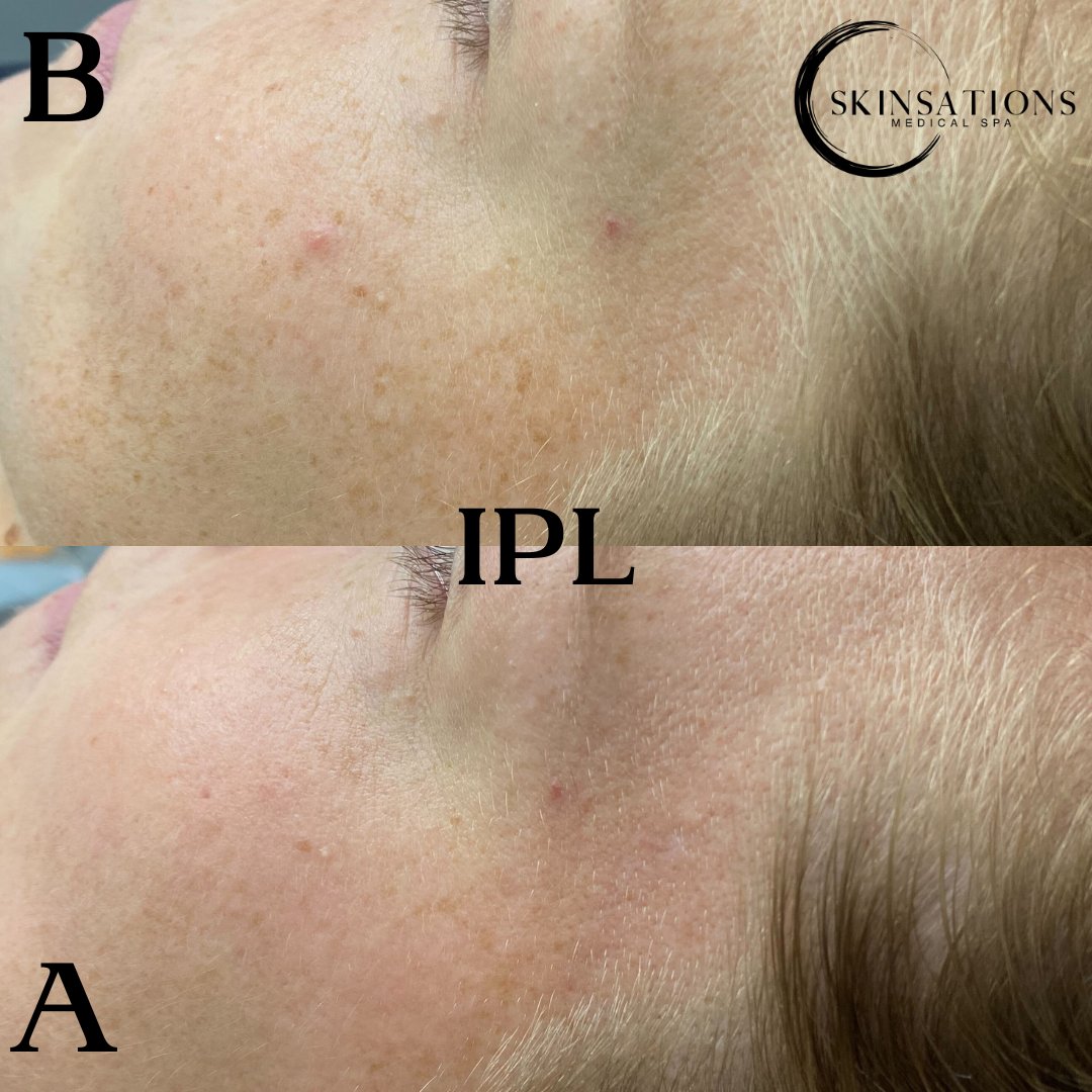 SkinsationsATL's tweet photo. ✨ Transformation Tuesday!✨
It's finally Fall &amp; IPLs are IN! Get rid of those sun spots, dark marks, and freckles in time for next summer.

5 for $400 Mix &amp; Match: IPLs, Photofacials, Chemical Peels, Dermaplanes, and Microderms! *Limited Time Only* https://t.co/zfGHLS4jtZ