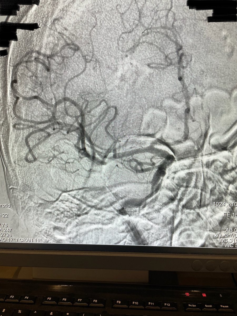 PenNeuro's tweet image. US HCPs: @AdiIyerMD gets single-pass TICI 3 with #RED62 in this case out of Providence Holy Cross Medical Center. #REDglideDifference Rx only. For risk info: bit.ly/37YcYIU Clinical results may vary.