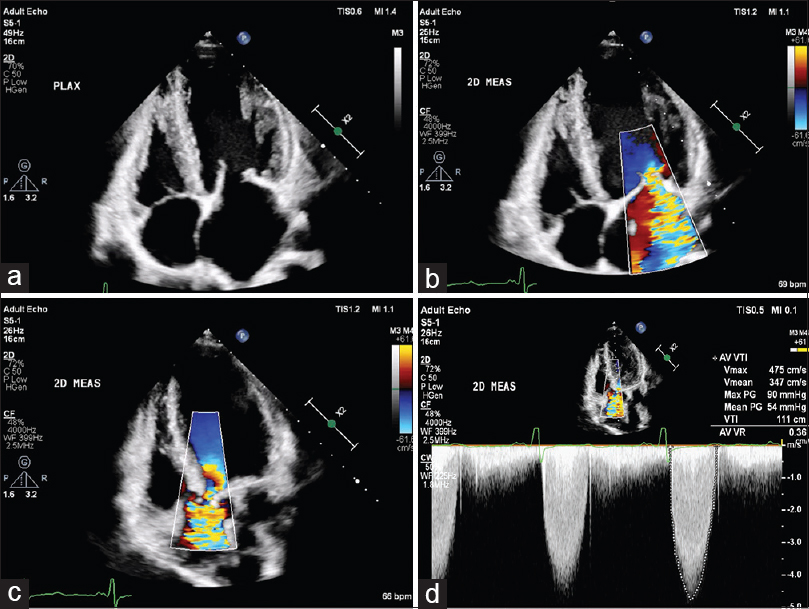 Bedside case for students (RHD) from Journal of Practice of Cardiovascular Sciences
j-pcs.org/article.asp?is…