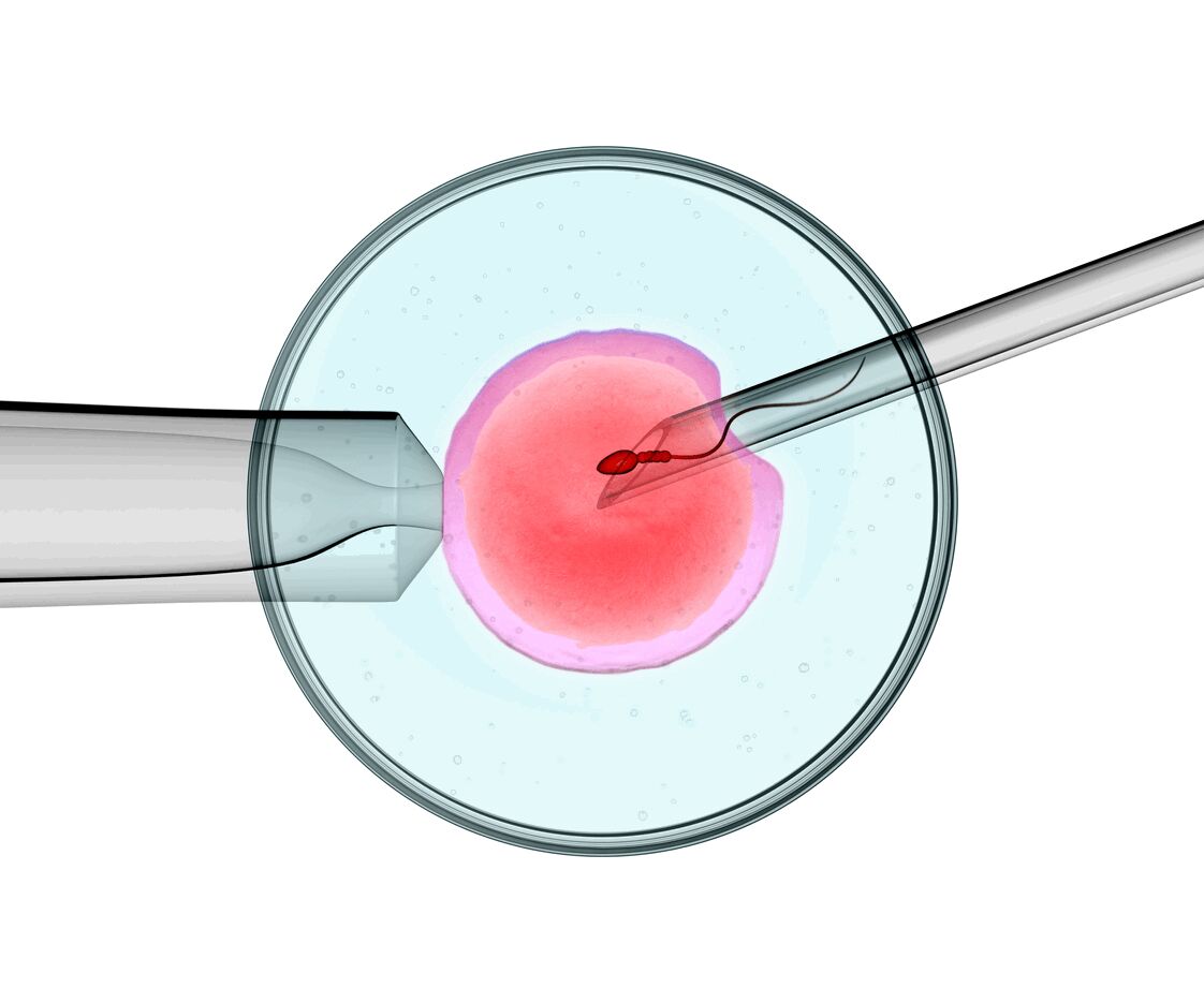 CalgaryRFP's tweet image. Intracytoplasmic Sperm Injection (ICSI) may be used as a means of facilitating fertilization. 

For some people experiencing infertility, ICSI may lead to successful pregnancy.   If you are interested in learning more, visit: bit.ly/3B2nrBm