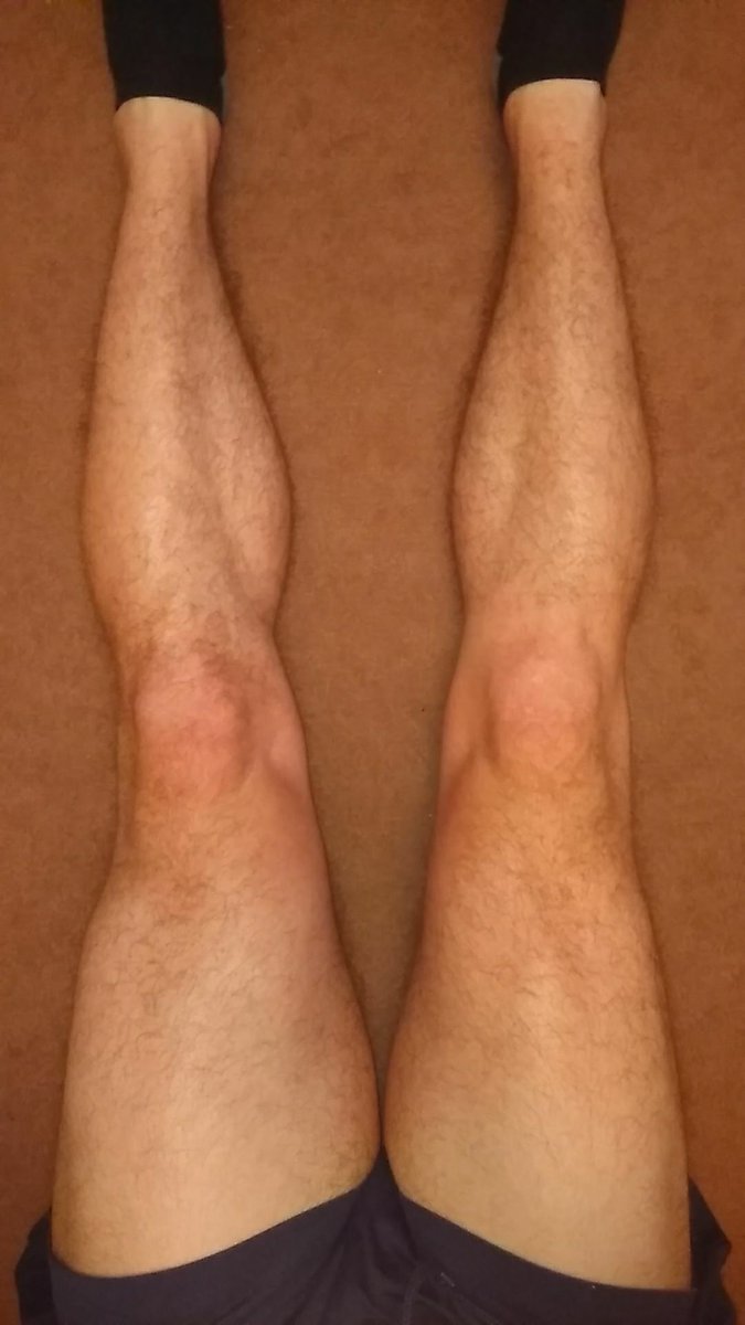TheACL_Recovery's tweet photo. RECOVERY JOURNEY PHOTOS 📸

Real Time photo of a knee (right) 46 weeks after undergoing ACL Reconstruction Surgery. If you want to read all about it check out my blog.

https://t.co/BDntmOoagk

#acl #aclrehab #sport #injury #theaclrecovery https://t.co/hMUI6xnsP9