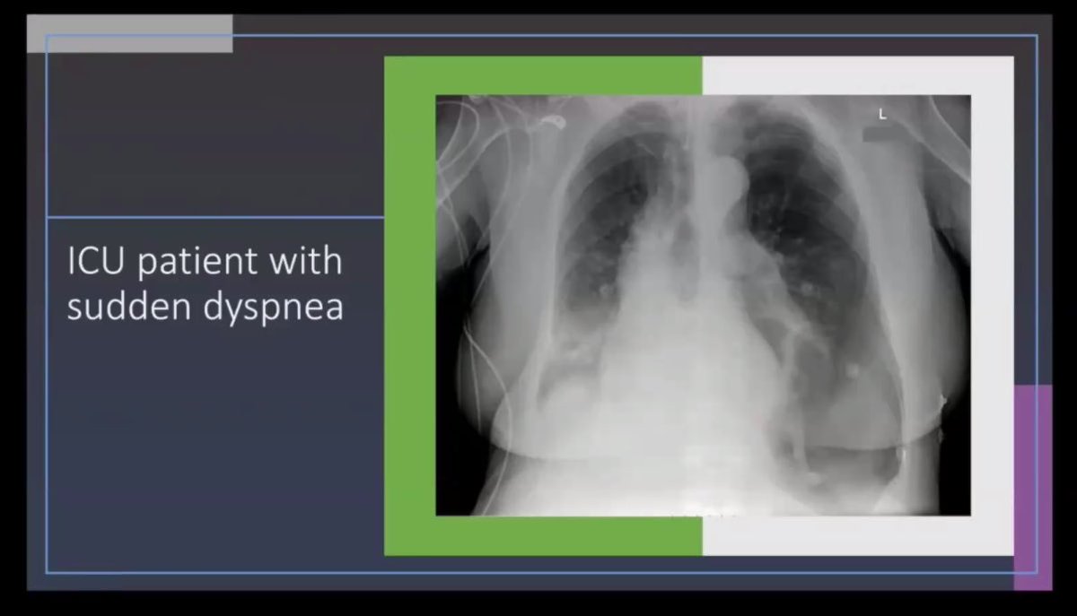 rzanetaMD's tweet photo. In an ICU patient with sudden dyspnea, this CXR revealed a Deep Sulcus Sign indicative of Left-Sided Pneumothorax. 

Seeing thru the Chest Xray
by Dr Andres
#IMPowered2022 https://t.co/3a4AGTNI60
