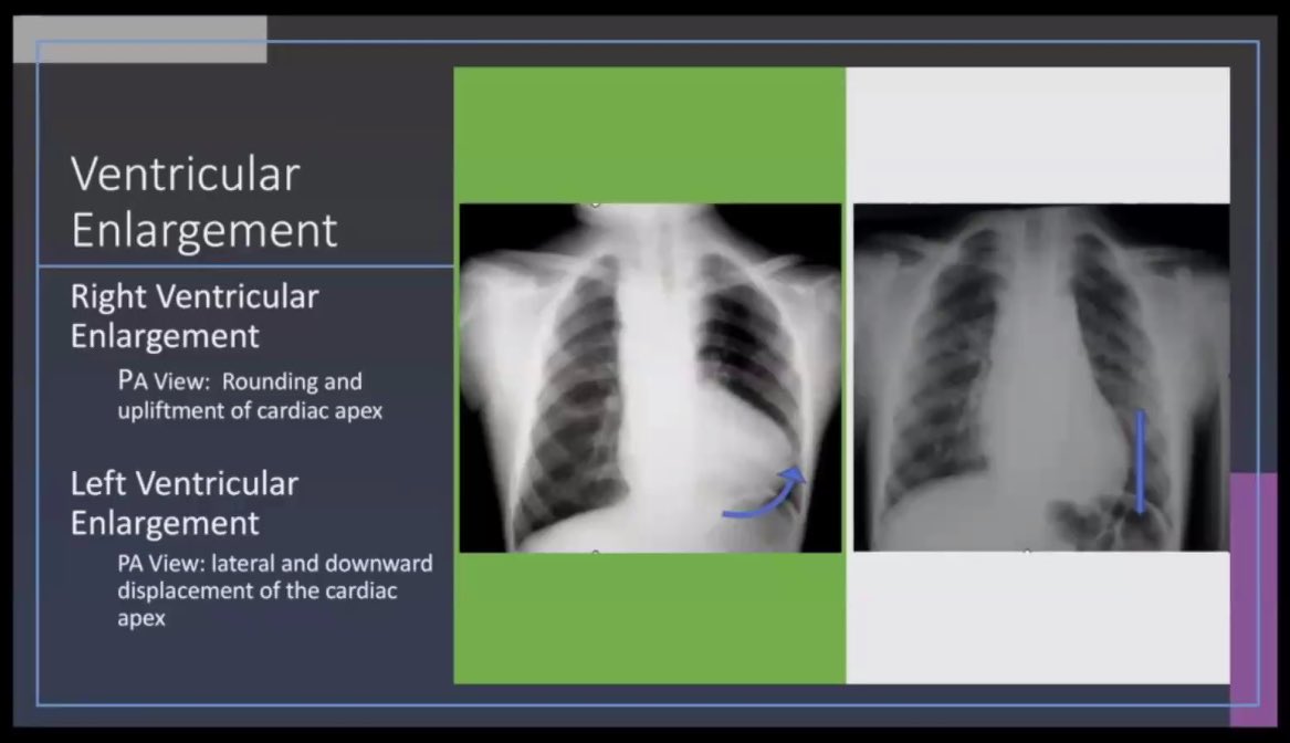 rzanetaMD's tweet photo. How to differentiate Ventricular Enlargement on CXR: Right vs Left. 

Seeing thru the Chest Xray
by Dr Andres
#IMpowered2022 https://t.co/DZEVslrGV8