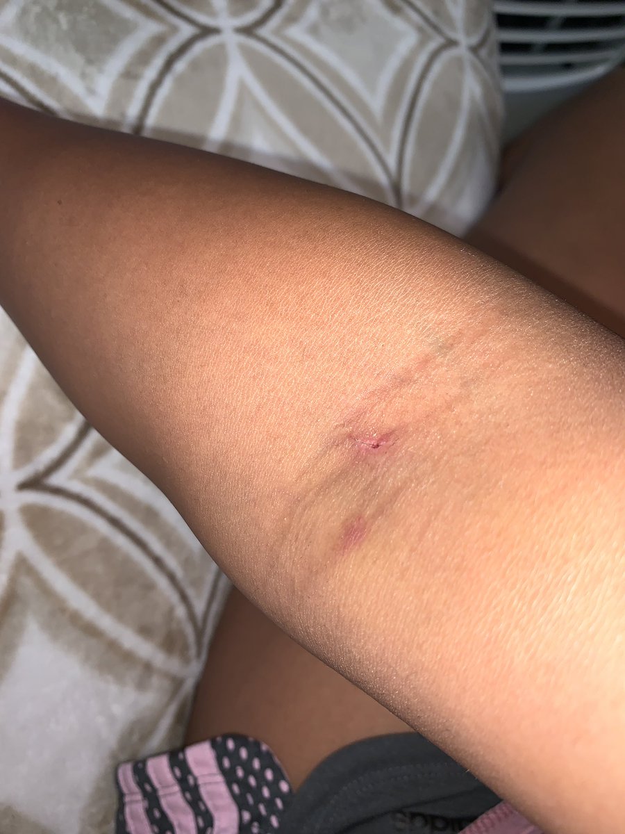 _1Life2Live_'s tweet photo. Donating plasma is nothing like donating anything else. Your arm needs recovery afterwards 😔 hope it at least saves a life 🩸💉 https://t.co/FEy7yTNz7F