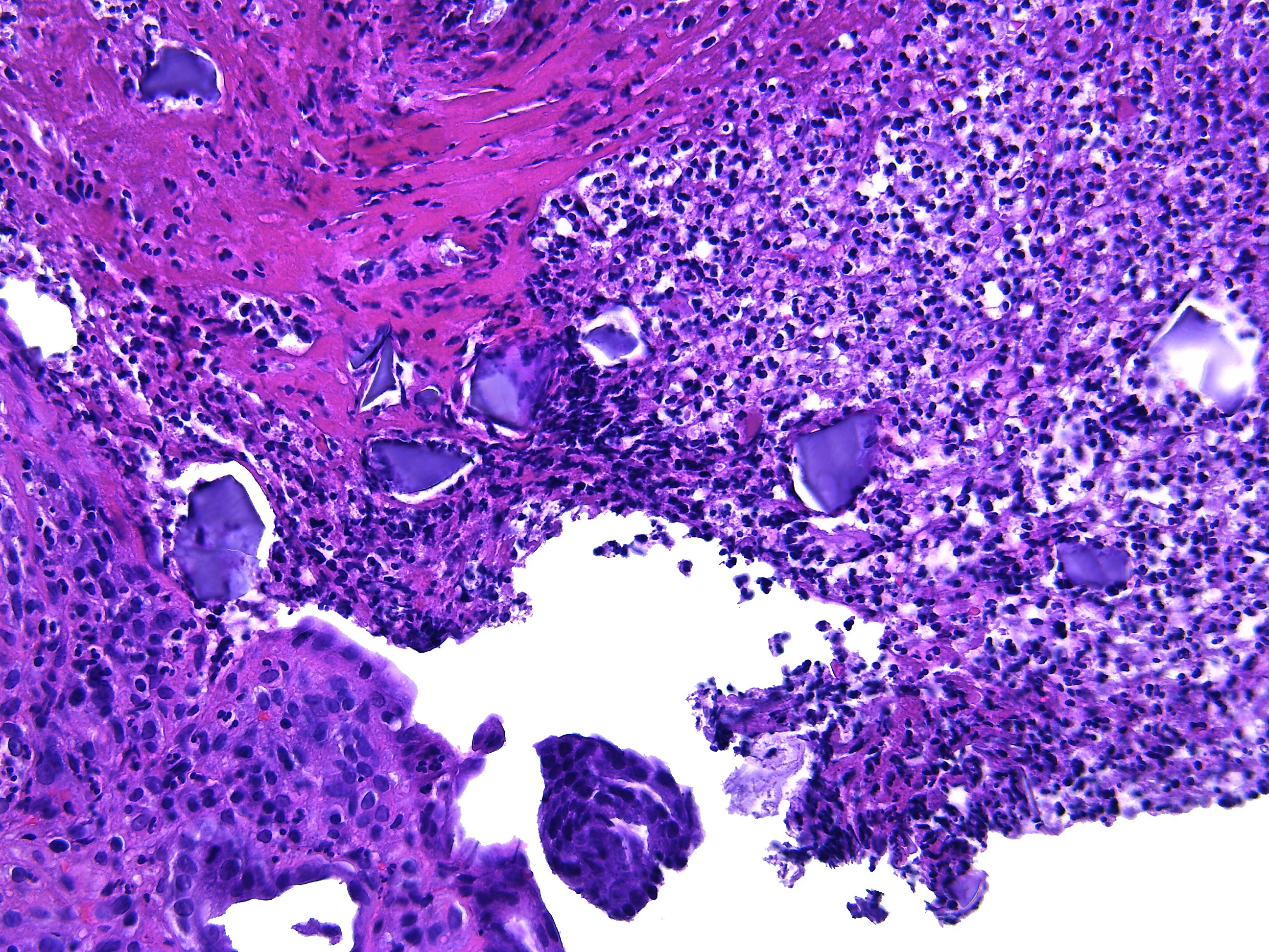 Pathology WalkerAuto Tweet Bot on Twitter "Kayexalateassociated