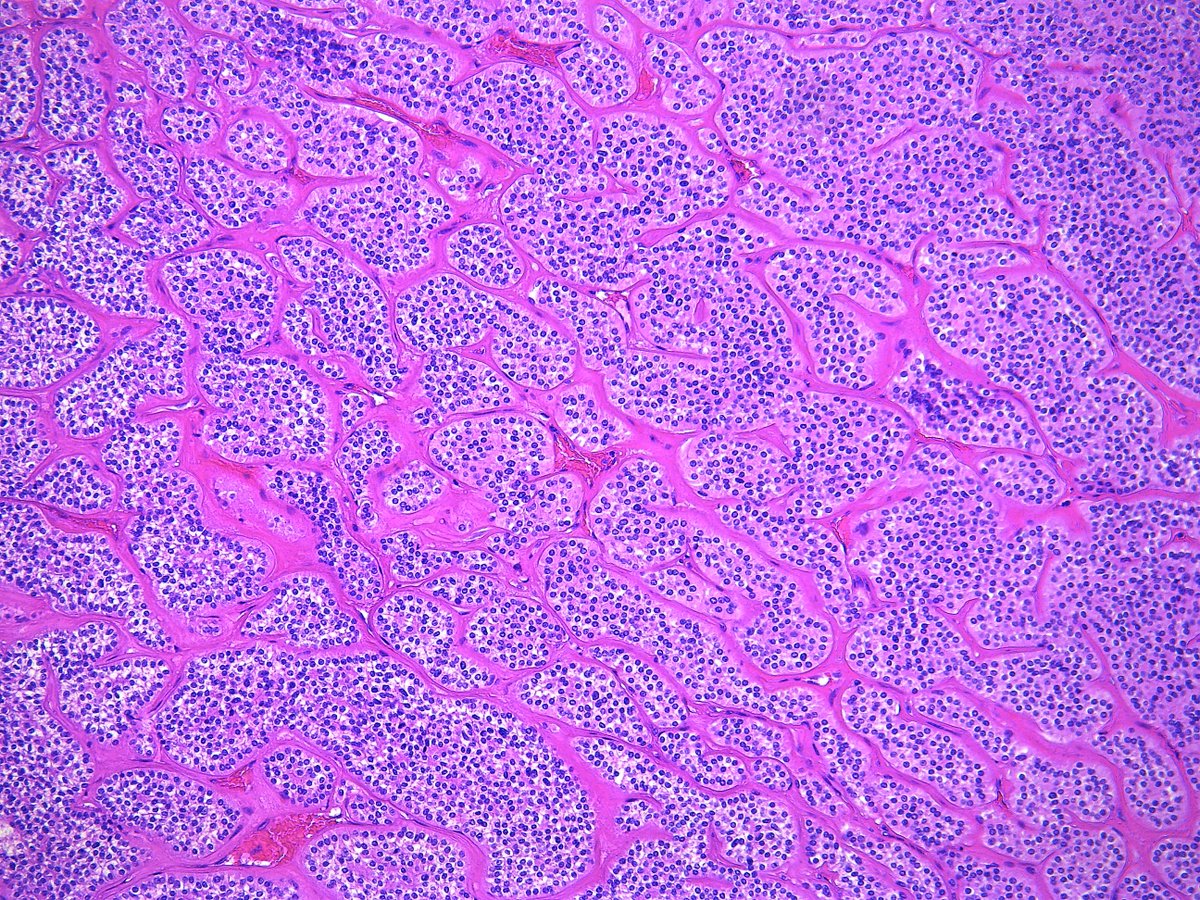 Patholwalker's tweet photo. Parathyroid carcinoma. HE and Elastica van Gieson #Pathology #Pathologist #EndPath https://t.co/lEAAatBFso